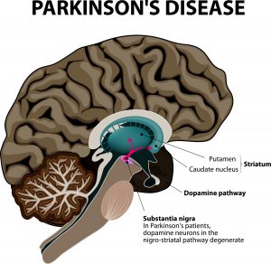 NUCCA and Parkinson's disease