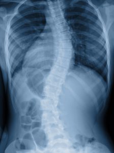 NUCCA and scoliosis 